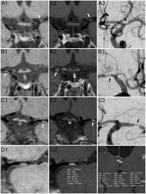 The fibrinogen-to-albumin ratio is associated with intracranial atherosclerosis plaque enhancement on contrast-enhanced high-resolution magnetic resonance imaging